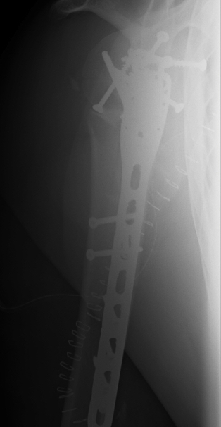 Proximal humerus ORIF 2